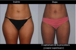 SculpSure- Dr Laura Anca Dermatology - www.ghidulmedical.com